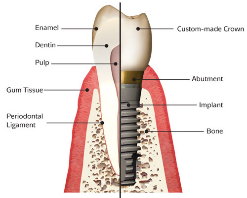 Dentus_dantu implantai 1