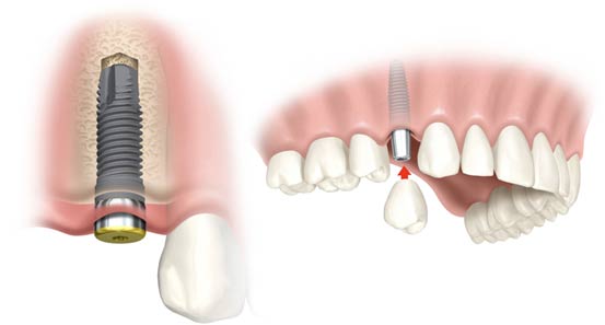 Dentus_dantu implantai 2