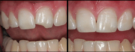 Dentus estetinis plombavimas