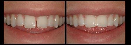 Dentus estetinis plombavimas2