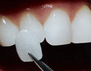 Dentus laminate
